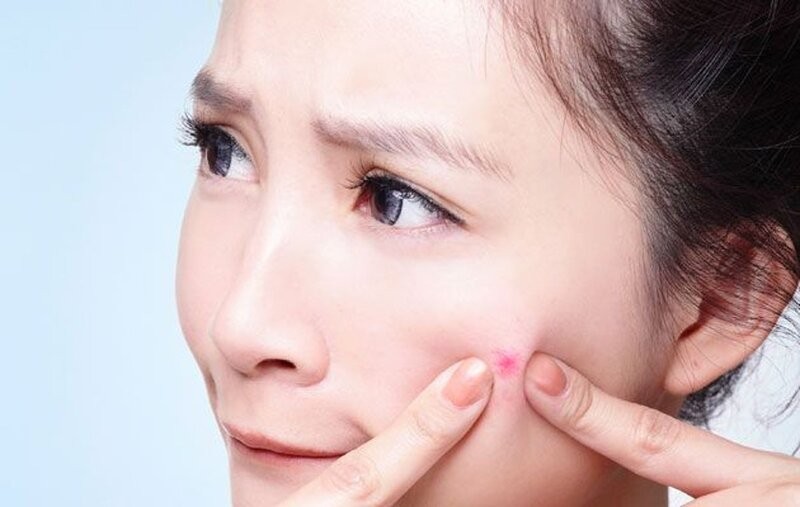 Bí quyết xóa sạch mụn do stress thi cử cuối năm- Ảnh 1. Bí quyết xóa sạch mụn do stress thi cử cuối năm- Ảnh 1.