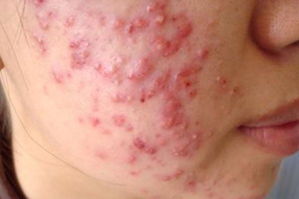 Cách sử dụng 3 hoạt chất thường dùng bôi trị mụn trứng cá- Ảnh 3. Cách sử dụng 3 hoạt chất thường dùng bôi trị mụn trứng cá- Ảnh 3.