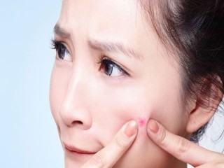 Bí quyết xóa sạch mụn do stress thi cử cuối năm